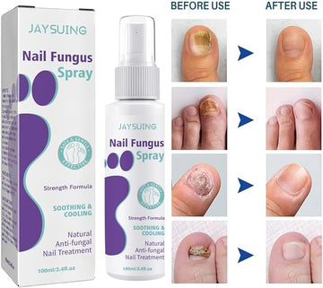 Nail Fungus Spray - Zabcart