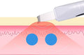 Face Blackhead Remover - Zabcart