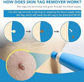 Acrochordon Skin Remover Kit - Zabcart