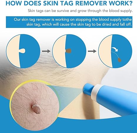 Acrochordon Skin Remover Kit - Zabcart