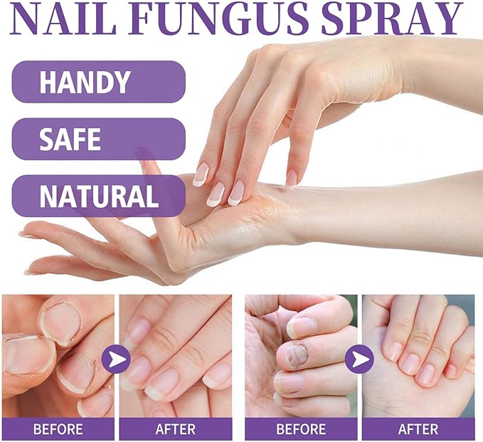 Nail Fungus Spray - Zabcart