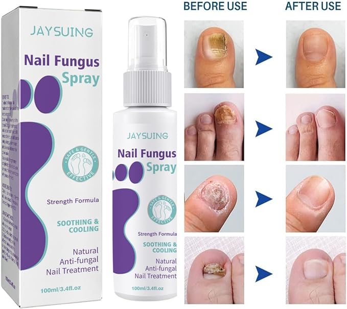 Nail Fungus Spray - Zabcart