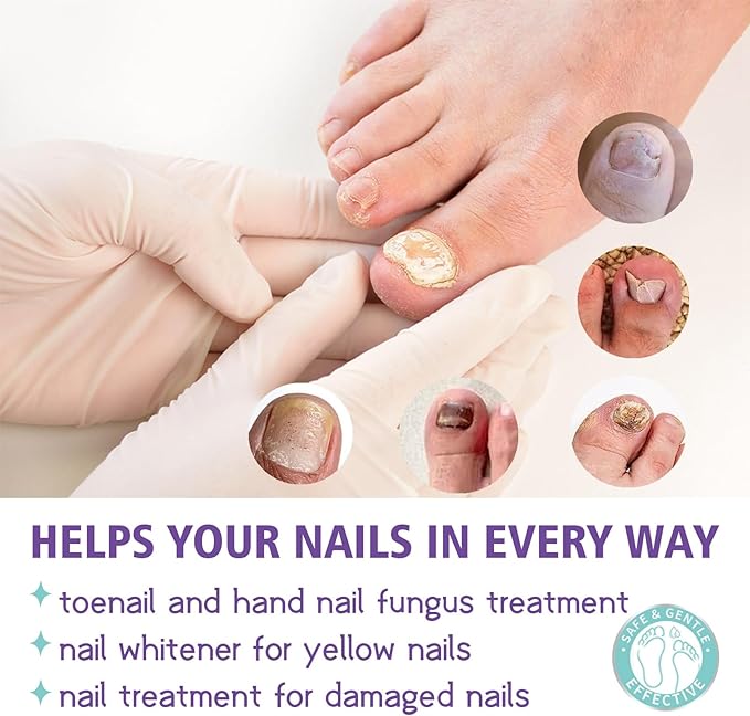 Nail Fungus Spray - Zabcart